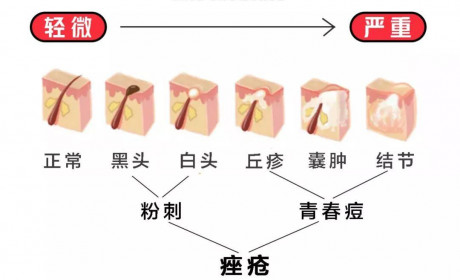 最良心的去黑头指南，拯救你的草莓鼻！